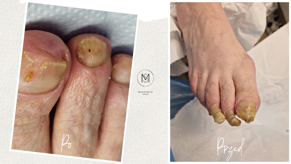 Rekonstrukcja paznokcia Magstudio (1)