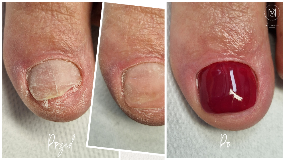 Rekonstrukcja paznokcia Magstudio (1)