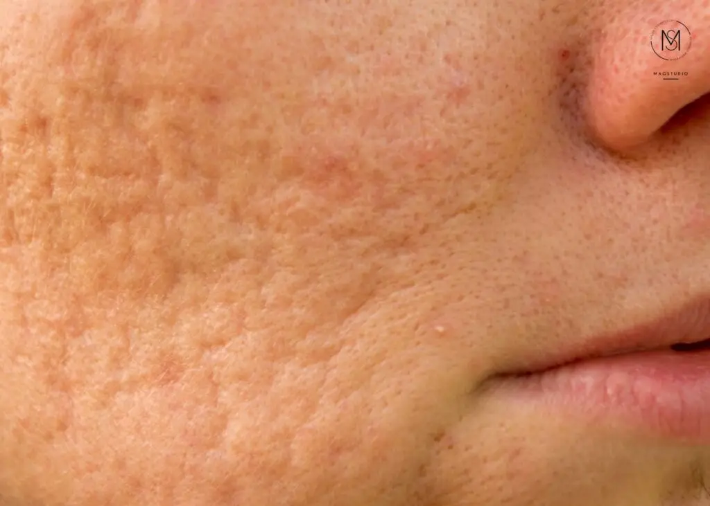 blizny potrądzikowe