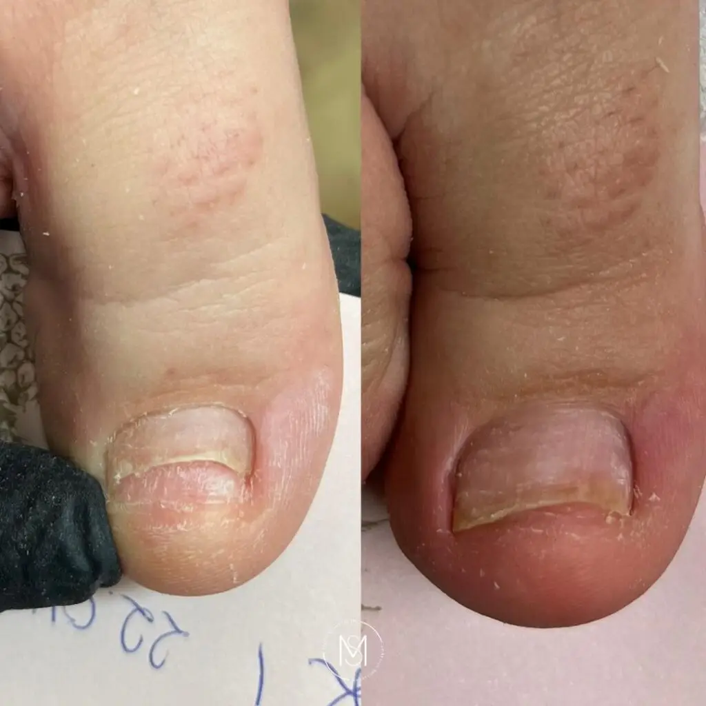 Podologia Zabiegi podologiczne