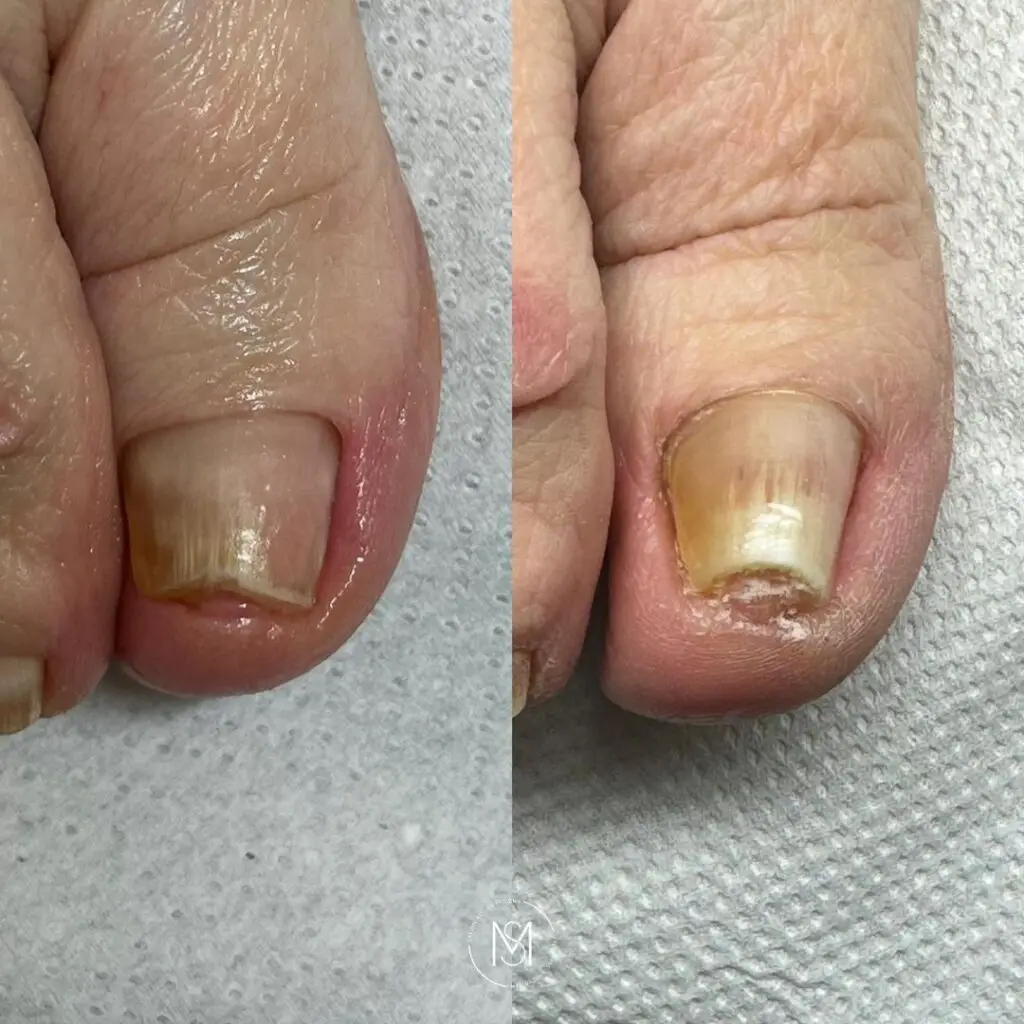 Podologia Zabiegi podologiczne