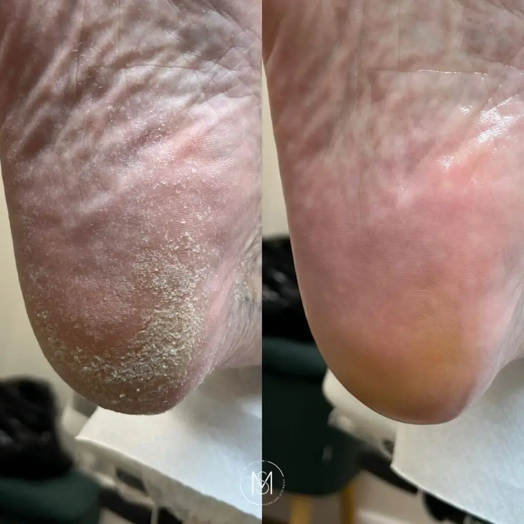 Podologia Zabiegi podologiczne