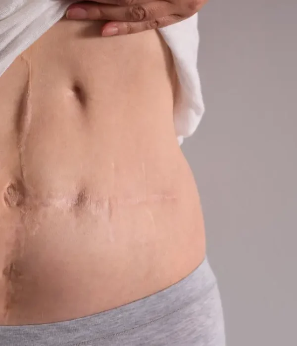 Radiofrekwencja mikroiglowa niwelowanie blizn